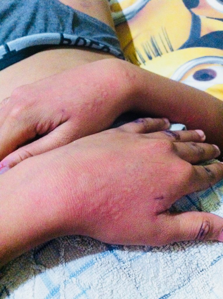 little boy with hives